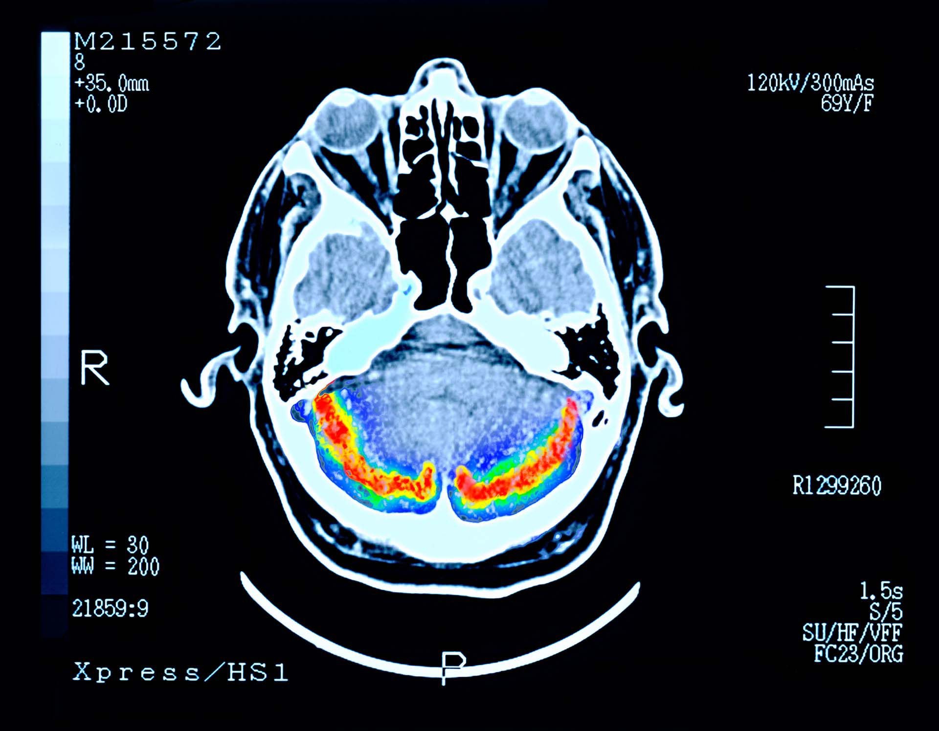 ALZHEIMER CEREBRO TENDENCIAS